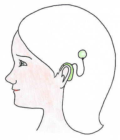 Figure 1 - A child with a CI.