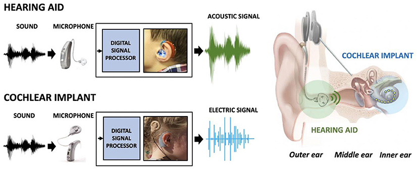 Figure 1 - Both hearing aids and cochlear implants record sound with a microphone and process it with a digital signal processor, to optimize the sound for the person’s hearing loss.