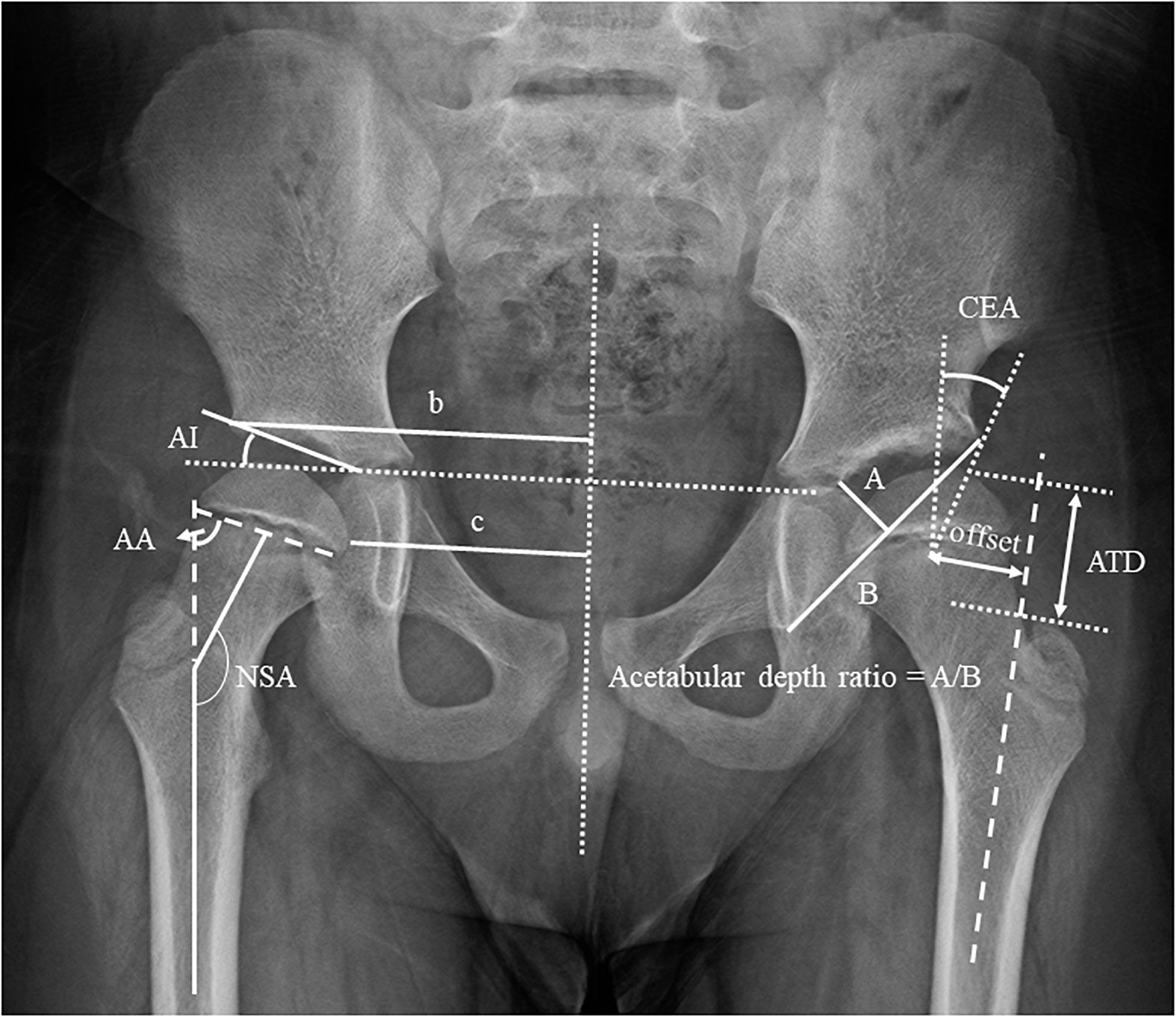 hip dysplasia normal hip xray