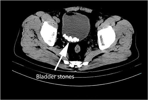 Frontiers Sexual Dysfunction In Patients With Urinary Bladder Stones But No Bladder Outlet 