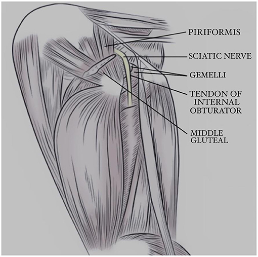 Sciatic Nerve Decompression: Background, Indications, Technical  Considerations