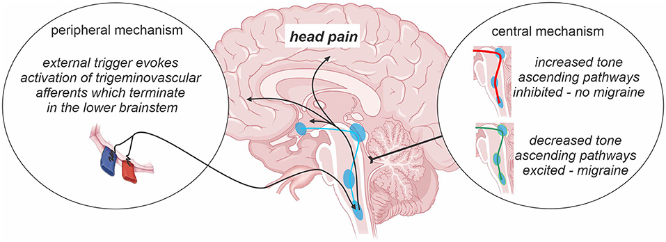 Ma migraine