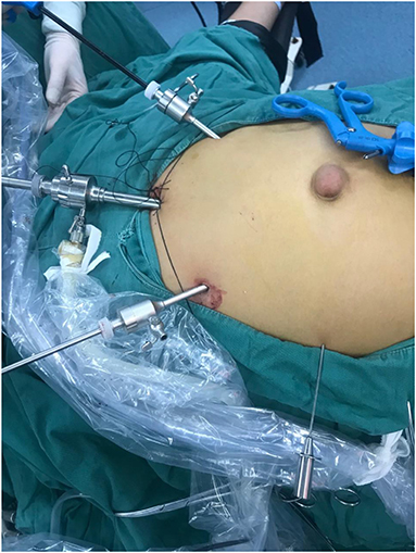 Frontiers  Case Report: 21 Cases of Umbilical Hernia Repair Using a  Laparoscopic Cephalic Approach Plus a Posterior Sheath and Extraperitoneal  Approach