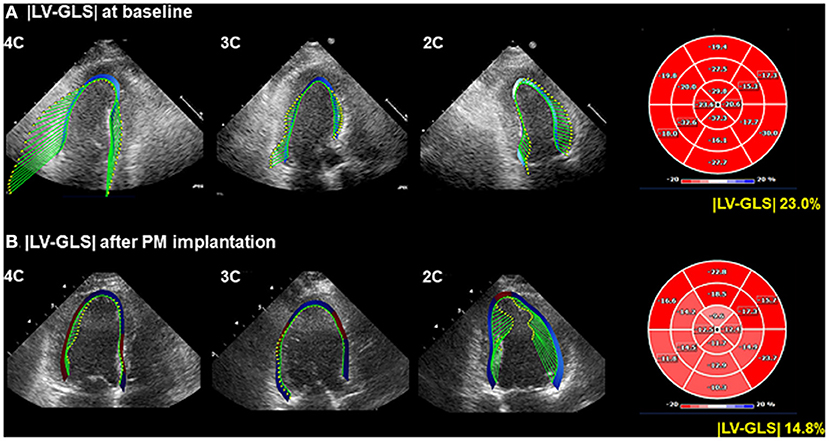 PDF] Value of global longitudinal strain by two dimensional speckle tracking  echocardiography in predicting coronary artery disease severity