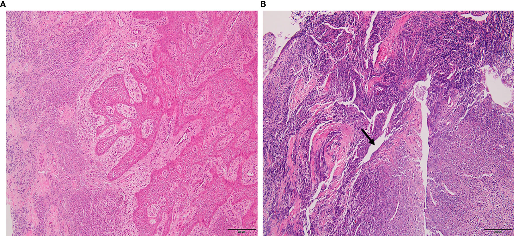 Periapical Abscess Histology