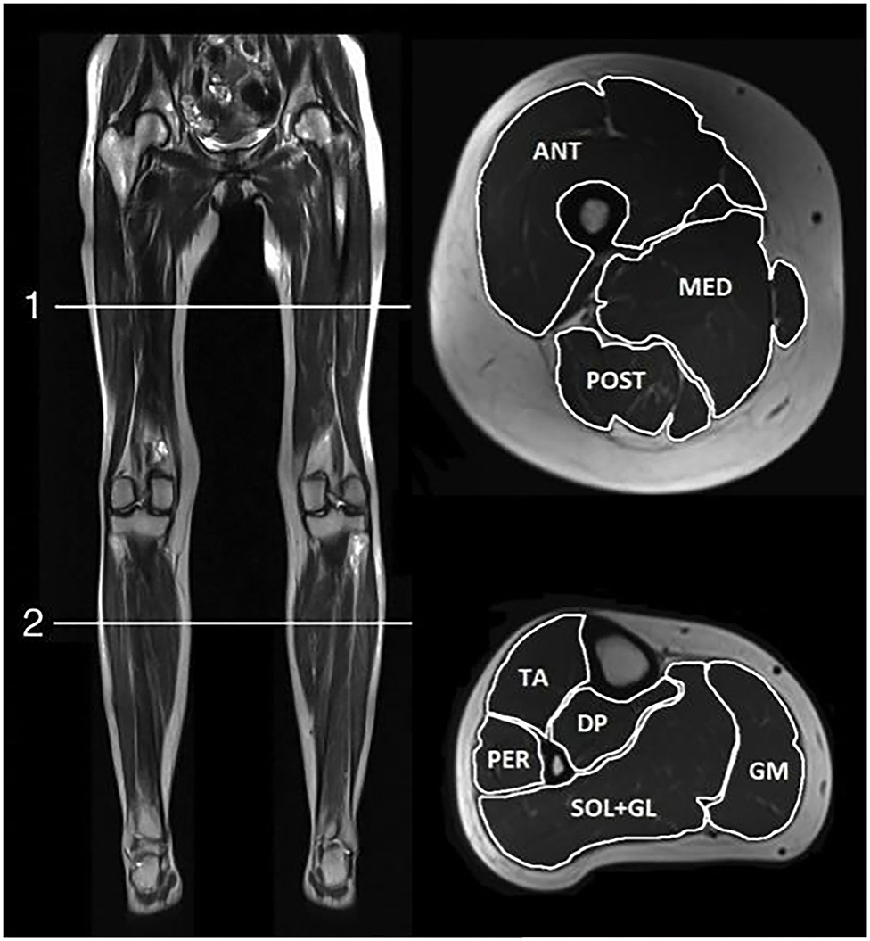 Frontiers | Quantitative Muscle MRI and Clinical Findings in Women With  Pathogenic Dystrophin Gene Variants