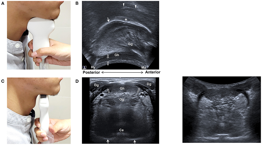 Frontiers  Emerging Role of Ultrasound in Dysphagia Assessment