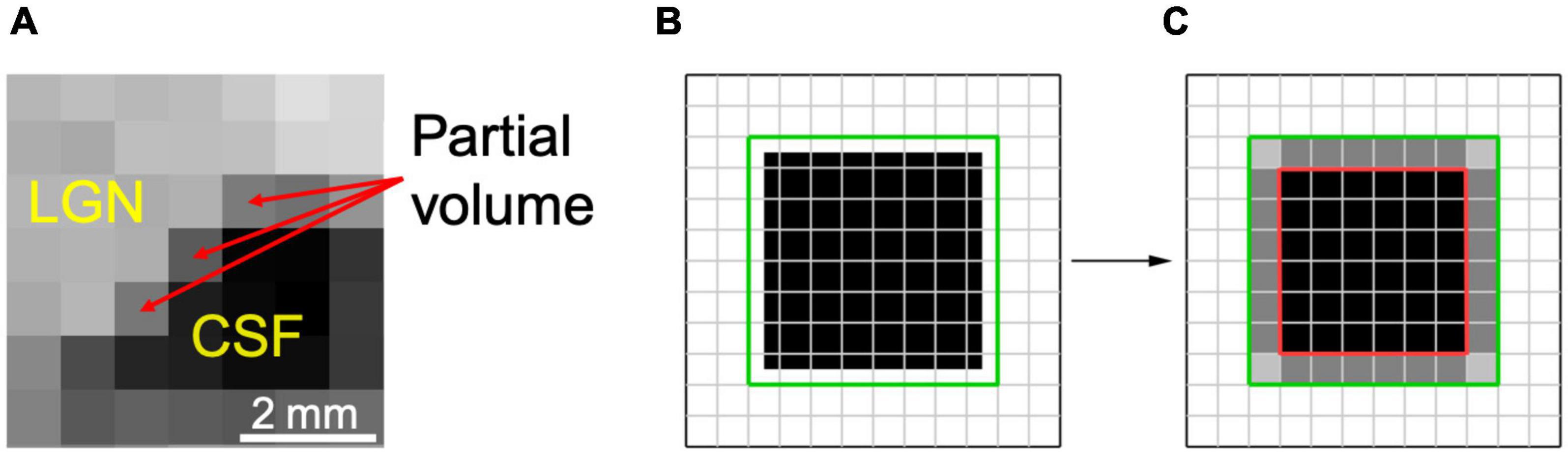 Measuring Connectivity in the Primary Visual Pathway in Human Albinism  Using Diffusion Tensor Imaging and Tractography