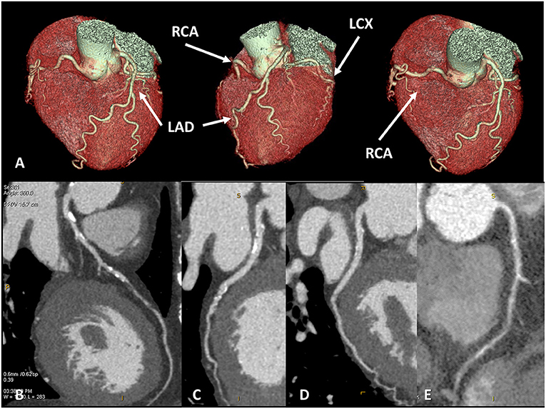 Frontiers The Potential Role Of Cardiac Ct In The Evaluation Of