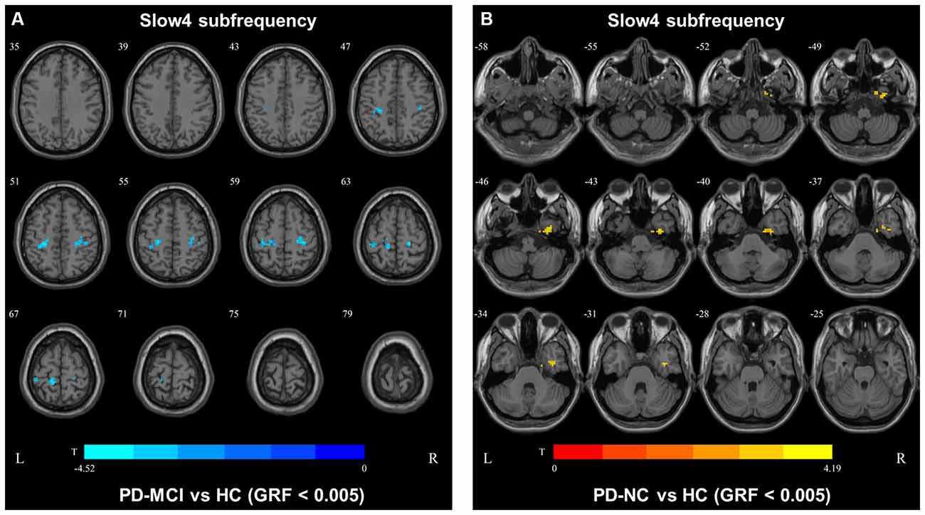 Frontiers  Abnormal brain spontaneous activity in major