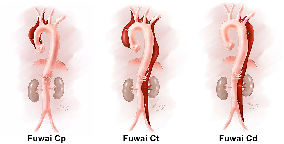 transverse arch aorta