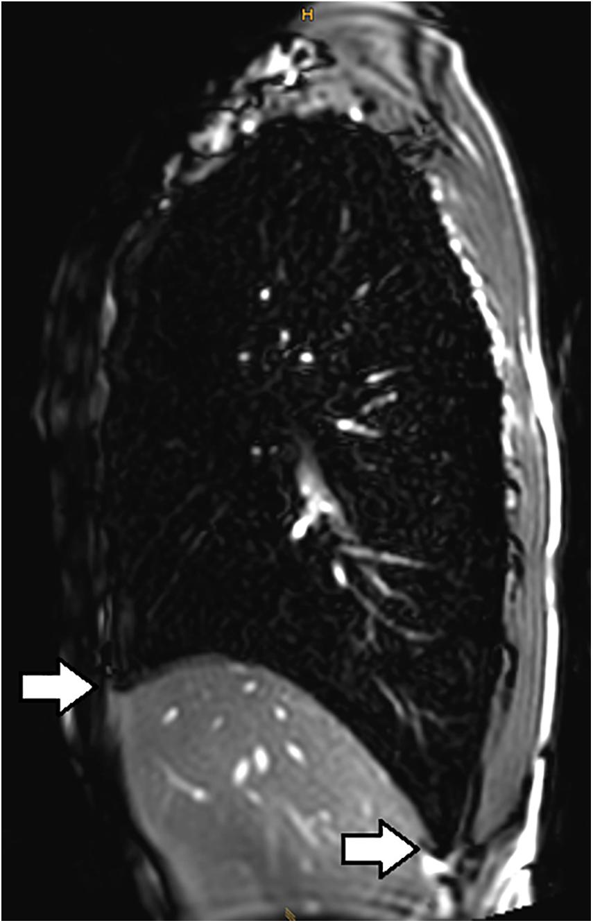 Frontiers Going to Extremes of Lung Physiology–Deep Breath-Hold Diving photo