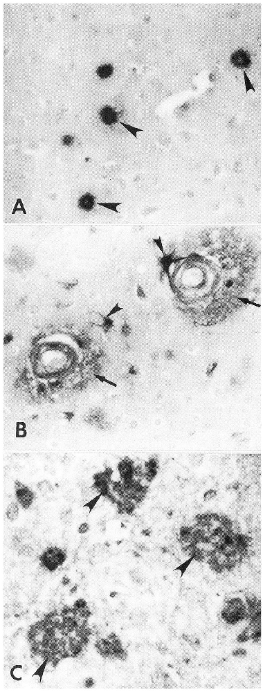 A Unifying Hypothesis for Alzheimer's Disease: From Plaques to