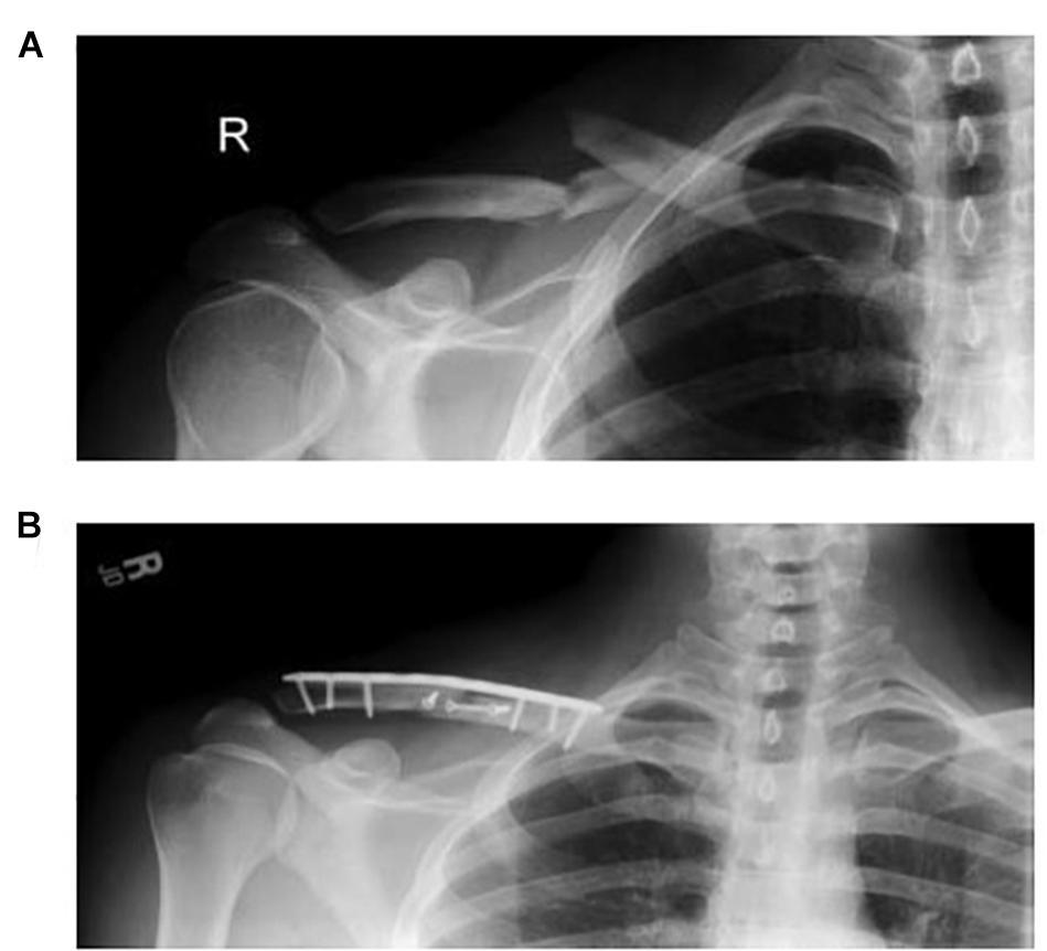 clavicle bone fracture