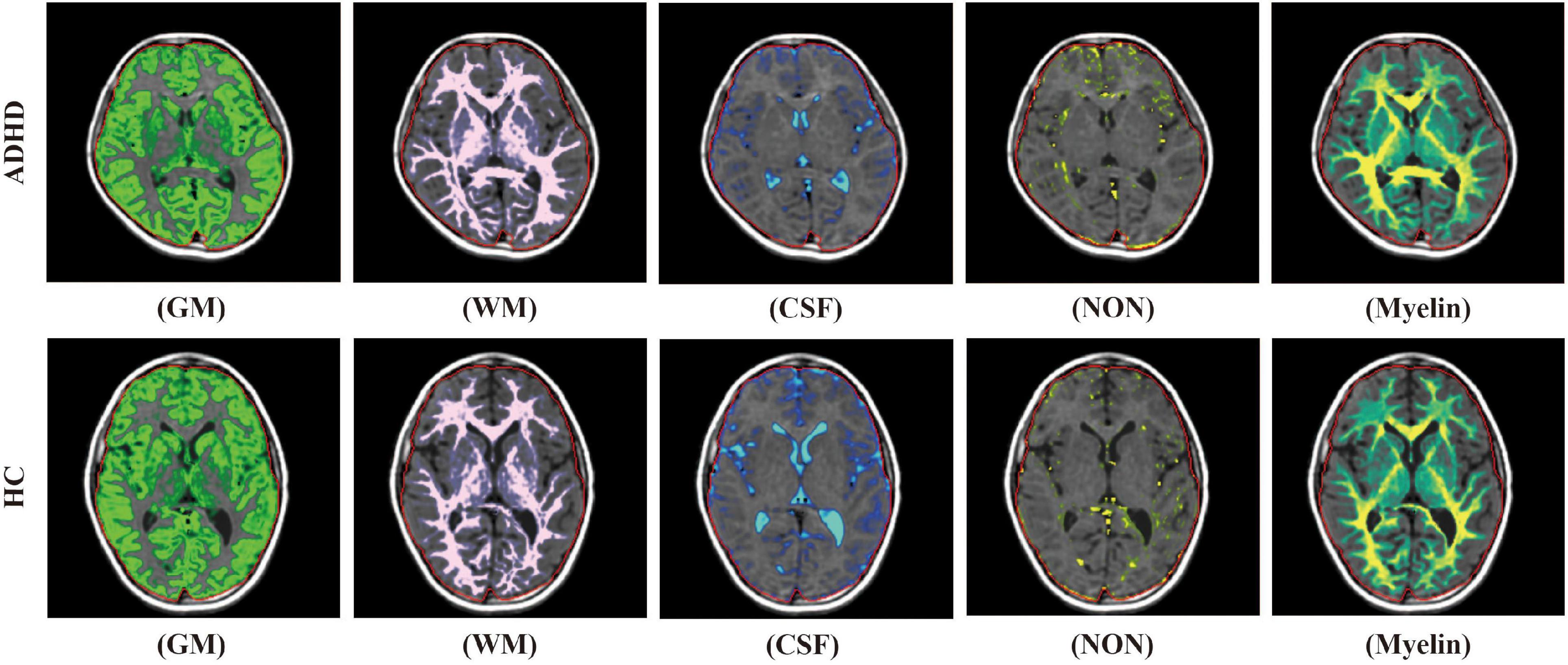 Attention Deficit Disorder Brain Compared To Normal Brain