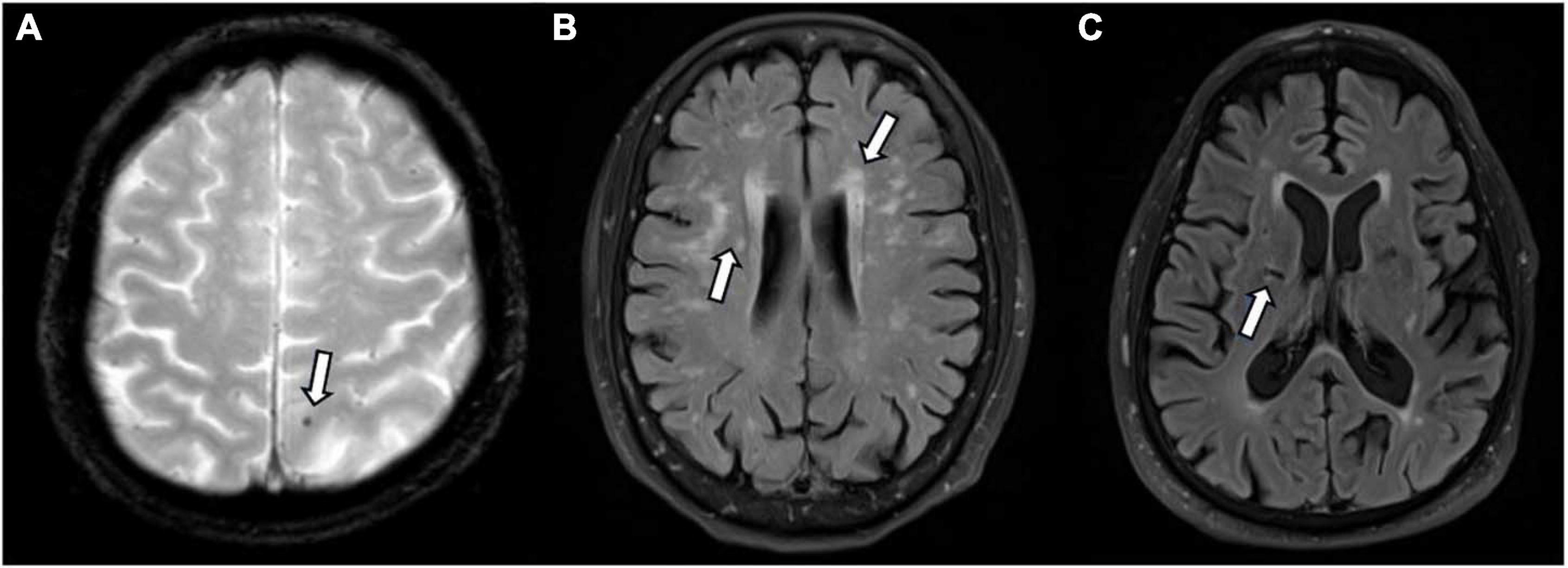 Frontiers | Increased Levels of Circulating Angiogenic Cells and ...