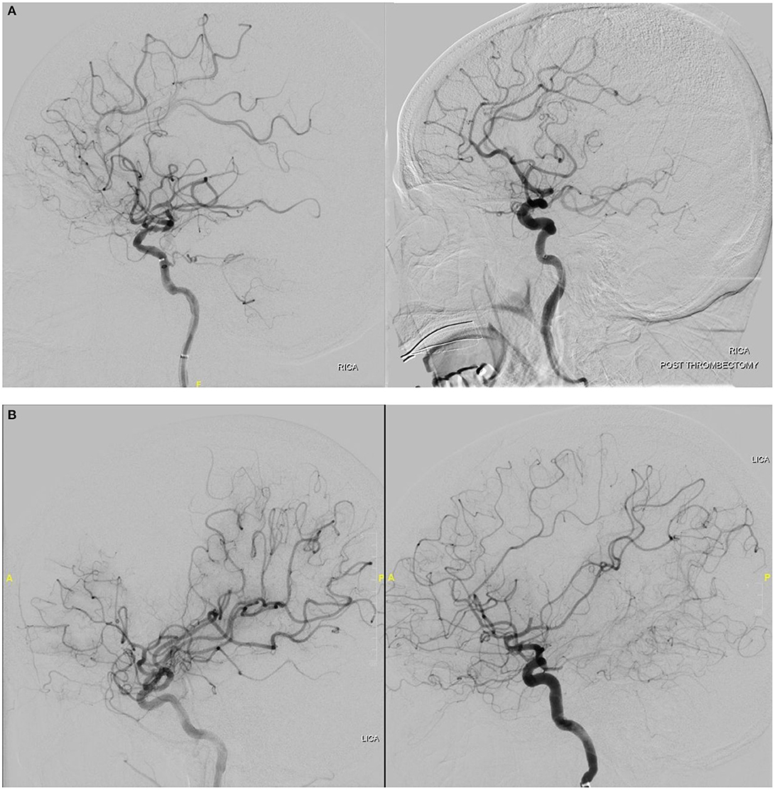 Endovascular – Aspiration Thrombectomy - Delta Surgical