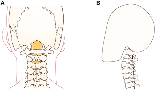 Frontiers  Case Report: Short-Term Spinal Cord Stimulation and Peripheral  Nerve Stimulation for the Treatment of Trigeminal Postherpetic Neuralgia in  Elderly Patients