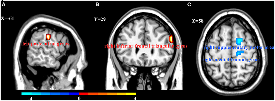Prevalence of medial depression of the mandibu- lar ramus (MDMR) in the