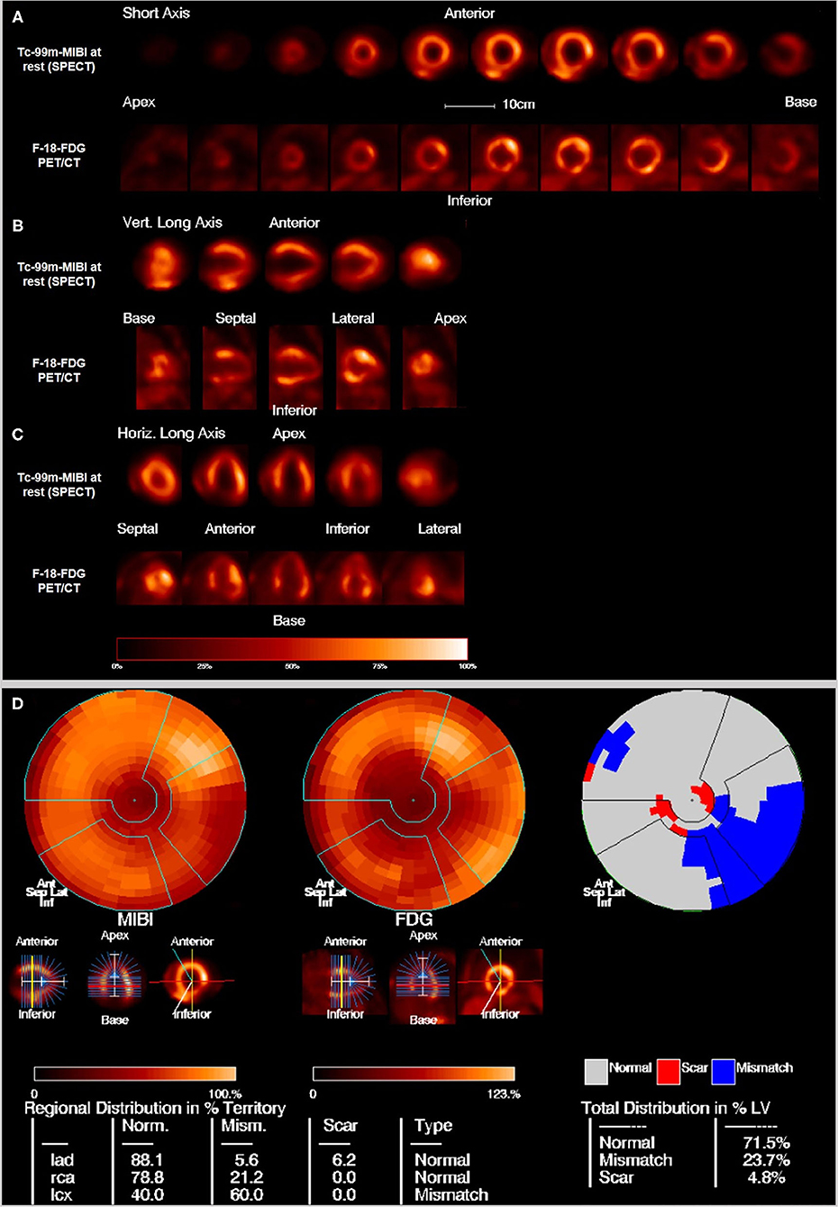 Table 4 from Visual assessment vs. strain imaging for the detection of  critical stenosis of the left anterior descending coronary artery in  patients without a history of myocardial infarction.