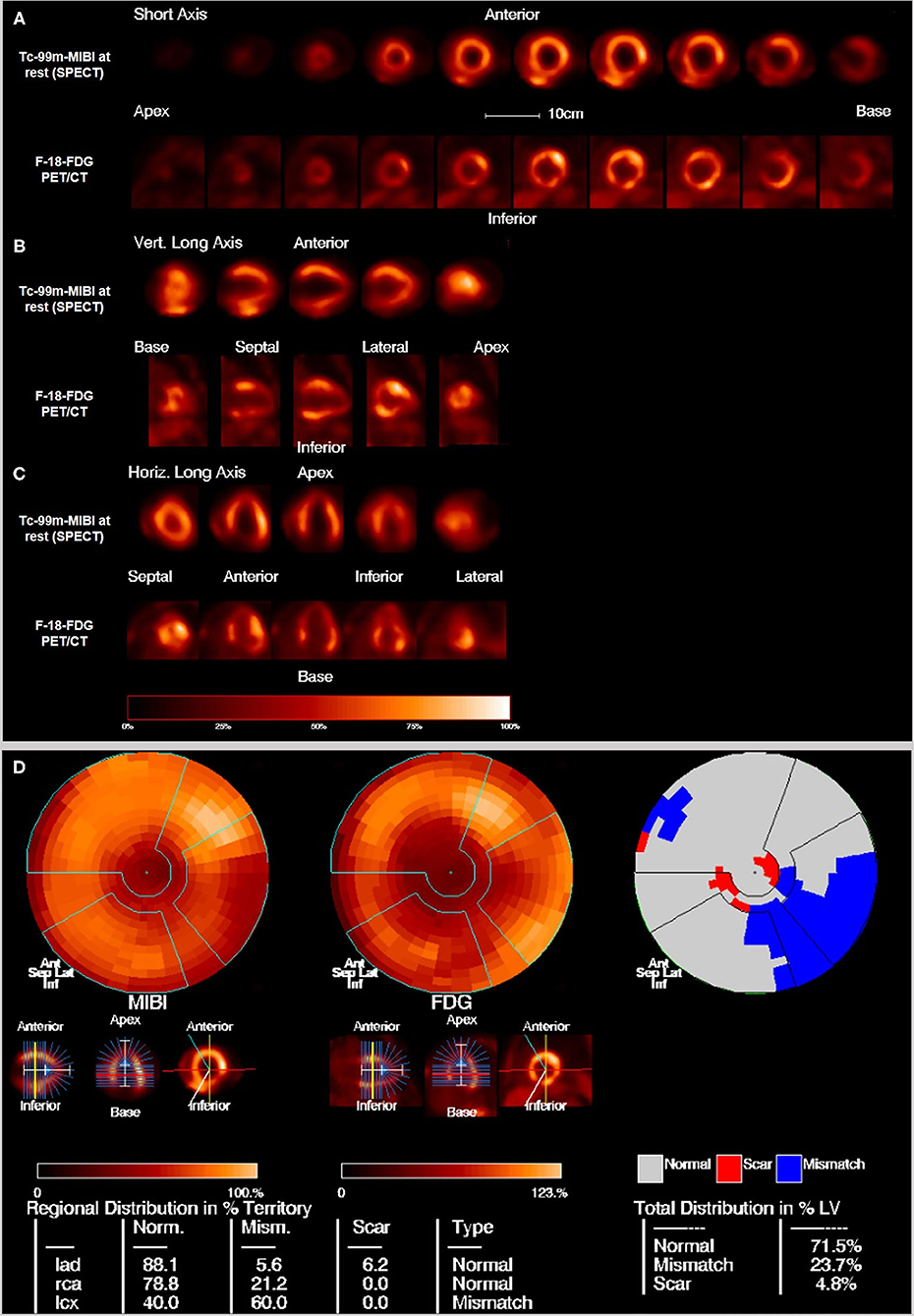 Left Ventricular Strain from Myocardial Perfusion PET Imaging: Method  Development and Comparison to 2-Dimensional Echocardiography