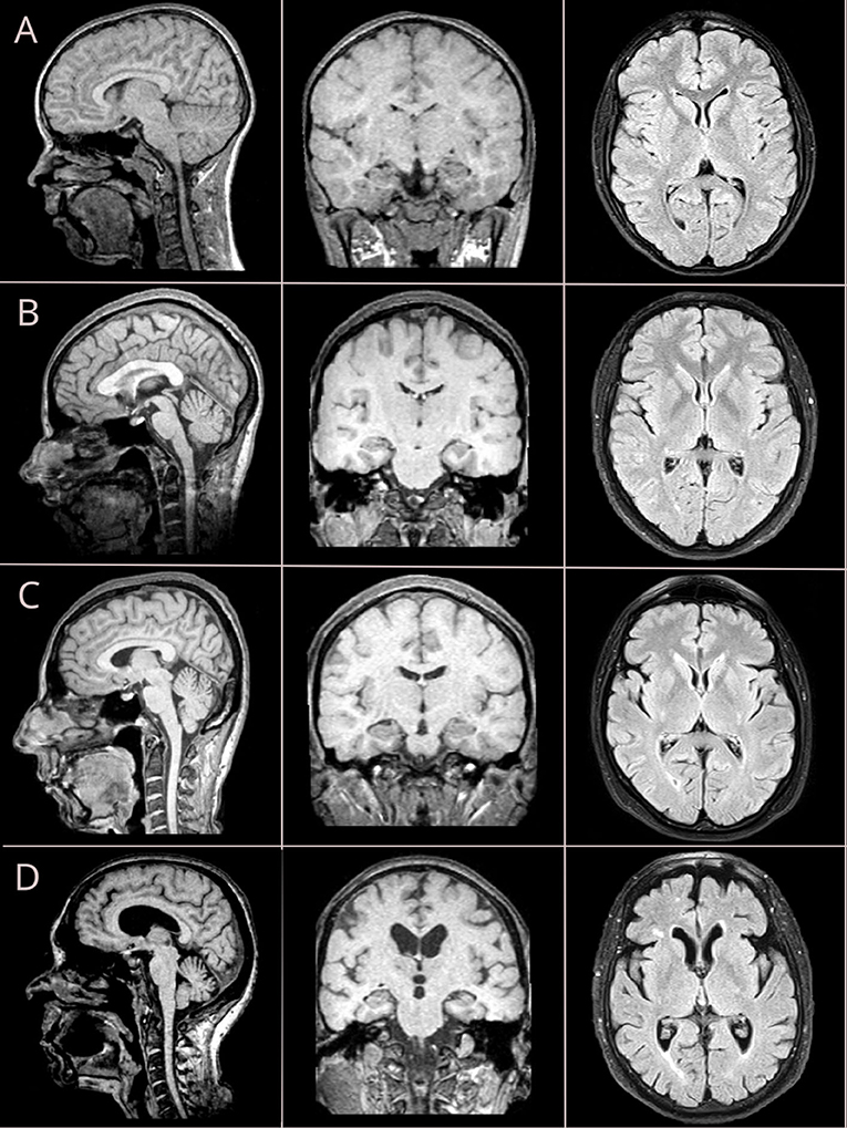 Normal Brain MRI.