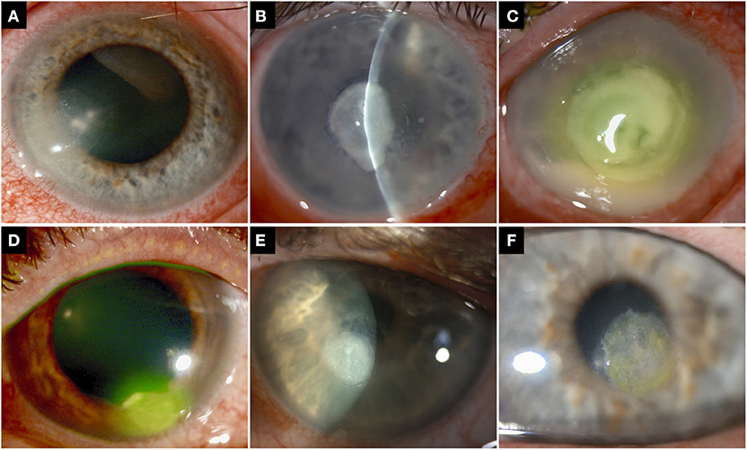 Frontiers | Risk Factors, Clinical Outcomes, and Prognostic Factors of Bacterial  Keratitis: The Nottingham Infectious Keratitis Study