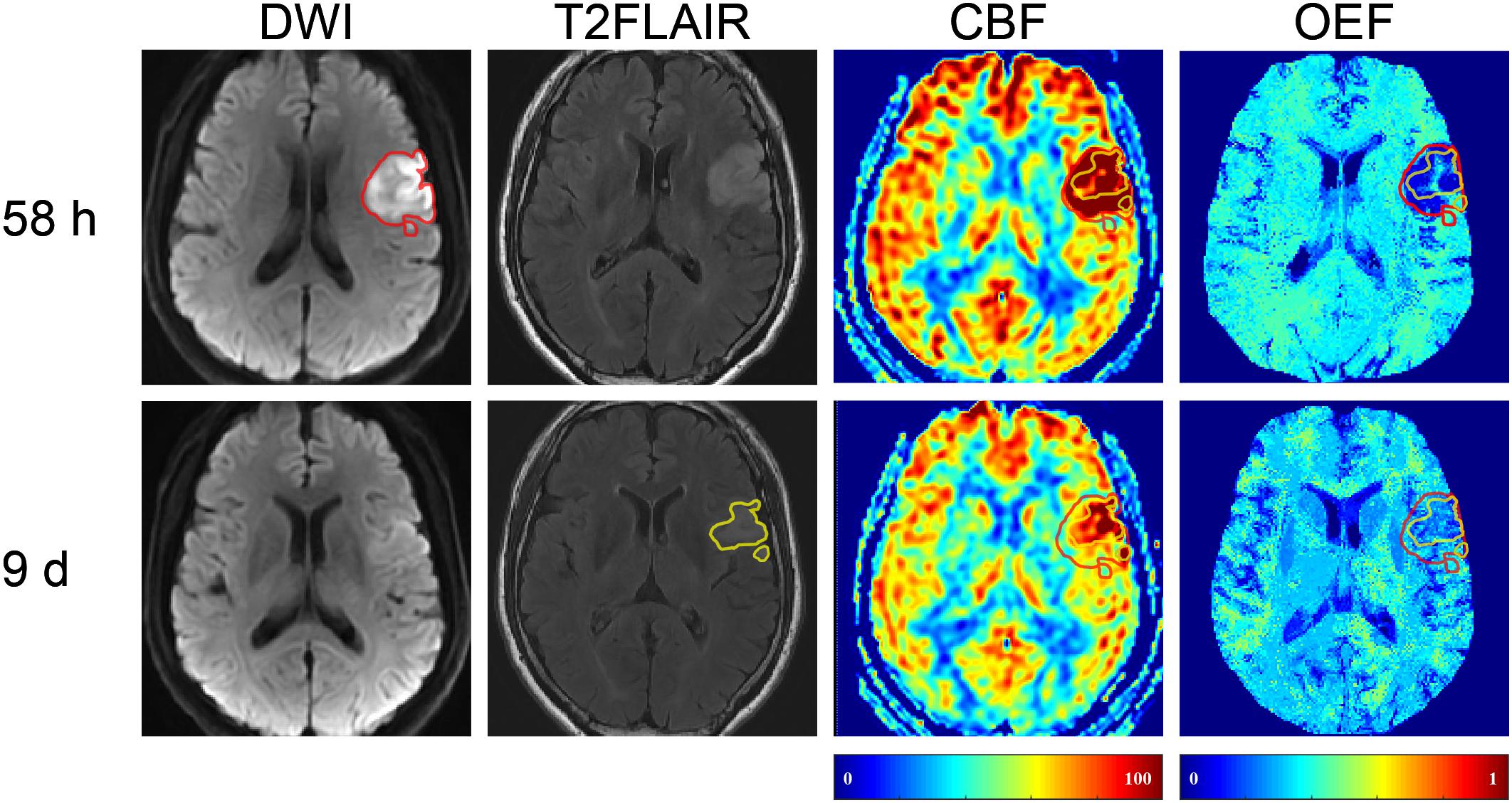 An example of non-contrast 3D turbo fi eld echo T1-weighted sequence of