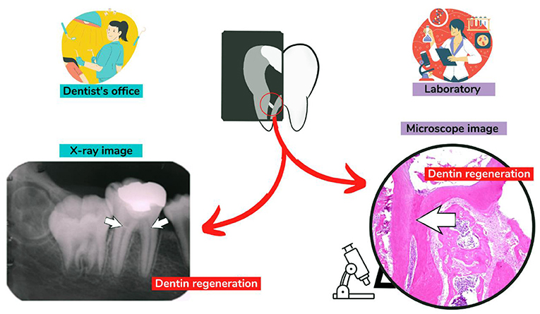 Figure 2 - Tooth regeneration seen on an X-ray and under a microscope.