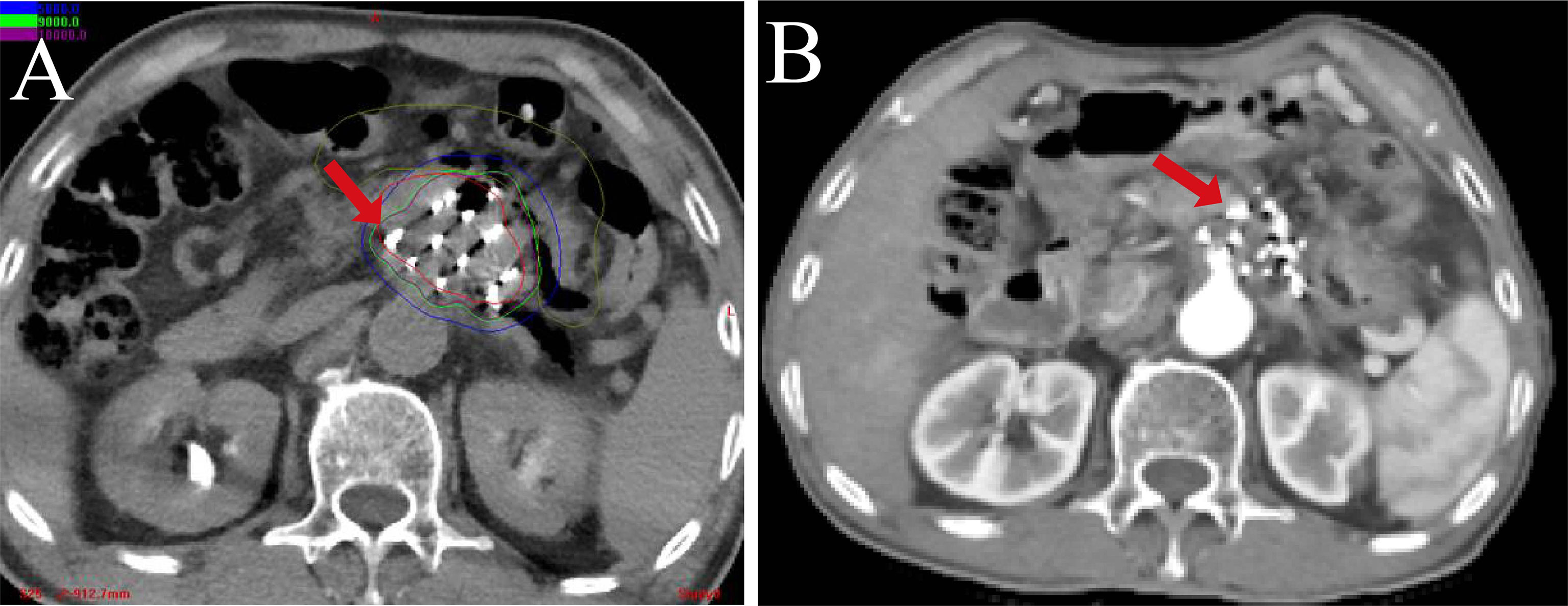 Localisation accuracy with iodine‐125 seed versus wire guidance for breast  cancer surgery - Ratnagobal - 2023 - Journal of Medical Radiation Sciences  - Wiley Online Library