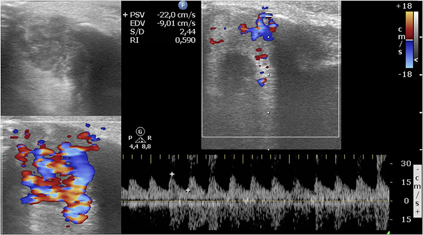 Doppler ultrasound: Uses, what to expect, and results