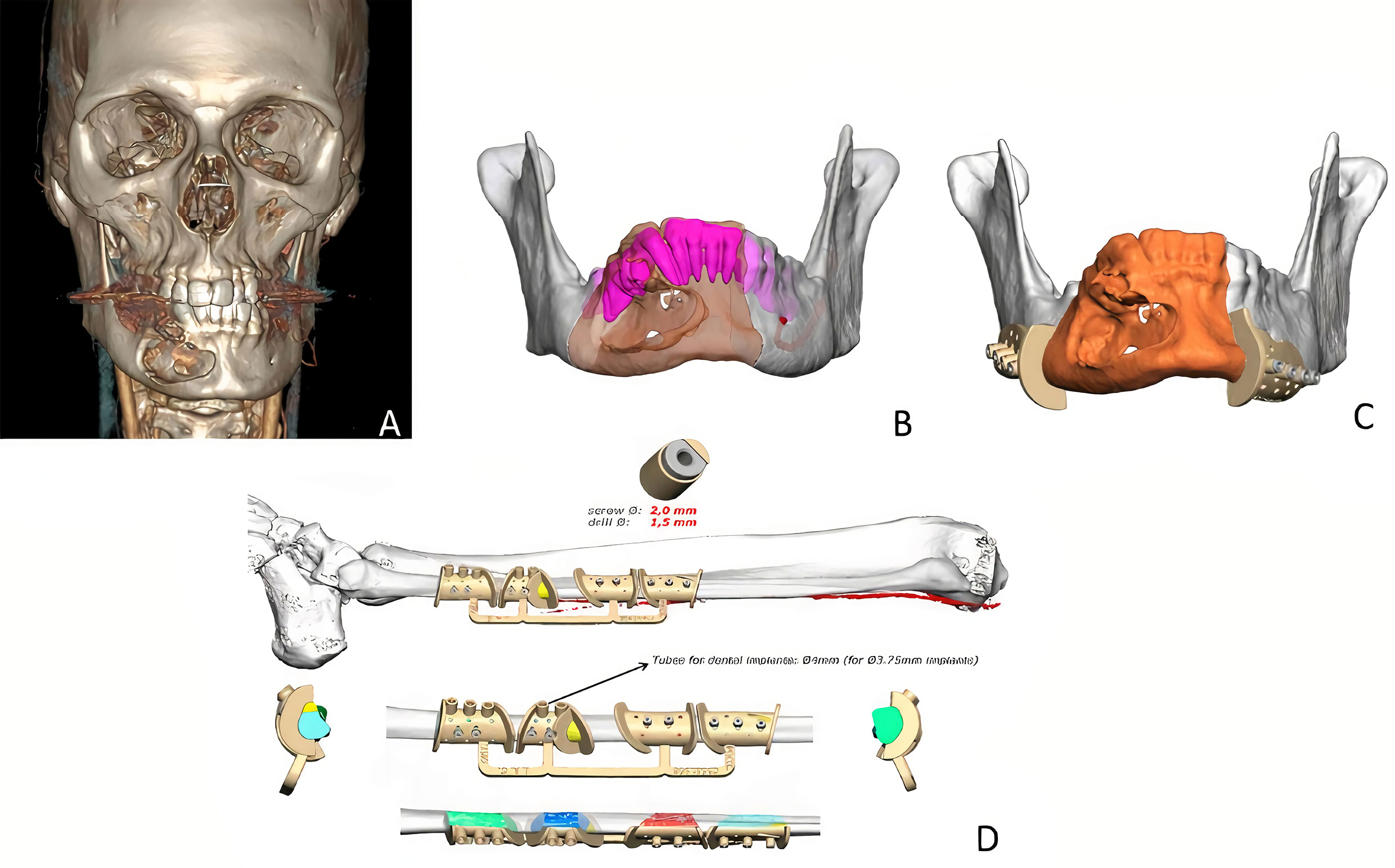 Reconstruction Of Mandibular Vertical Defects For Dental Implants With ...