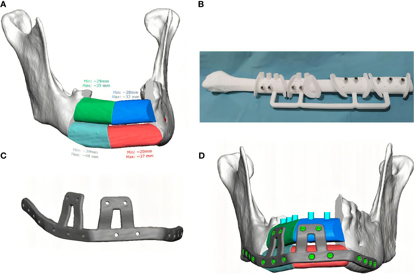 Using D Computer Planning For Complex Reconstruction Of Mandibular | My ...