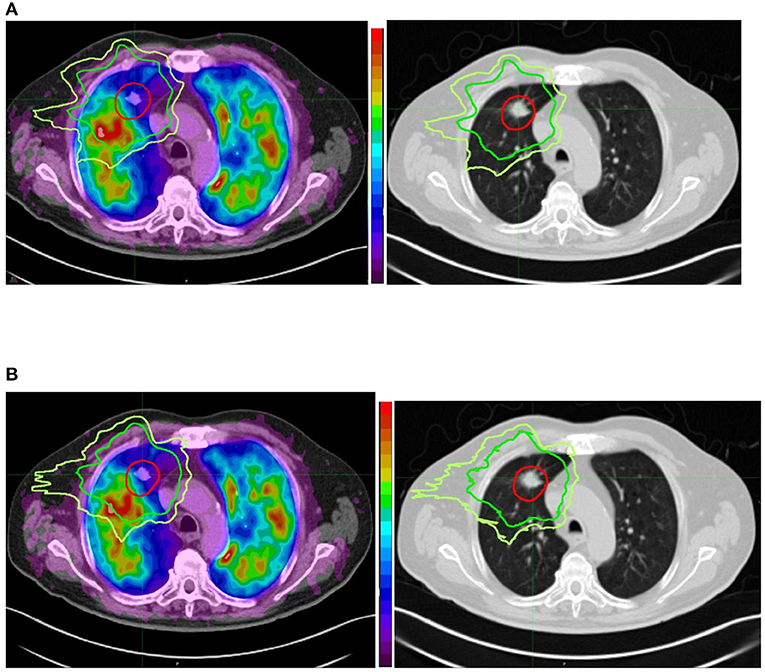 Frontiers  Radiation Therapy Planning of Thoracic Tumors: A Review of  Challenges Associated With Lung Toxicities and Potential Perspectives of  Gallium-68 Lung PET/CT Imaging