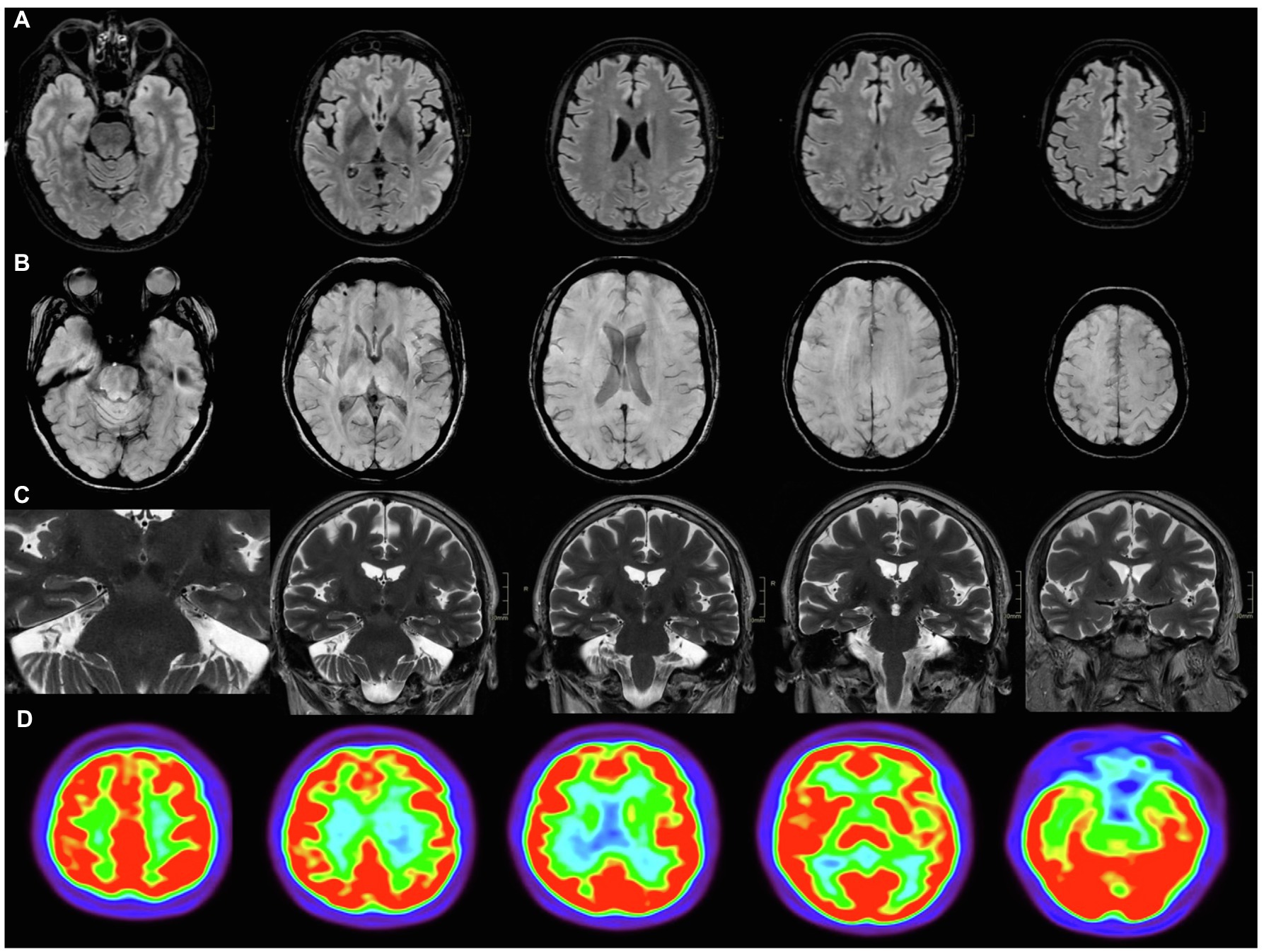 Frontiers  “Brain Fog” by COVID-19 or Alzheimer's Disease? A Case Report