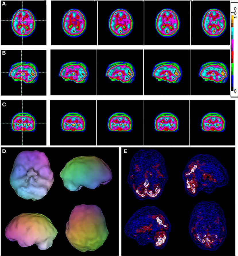 Frontiers | SPECT Functional Neuroimaging Distinguishes Adult Deficit Hyperactivity Disorder Healthy Controls in Big Data Imaging Cohorts