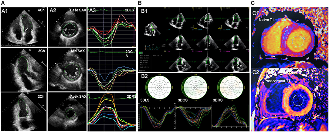 Frontiers  Association Between 2D- and 3D-Speckle-Tracking Longitudinal  Strain and Cardiovascular Magnetic Resonance Evidence of Diffuse Myocardial  Fibrosis in Heart Transplant Recipients