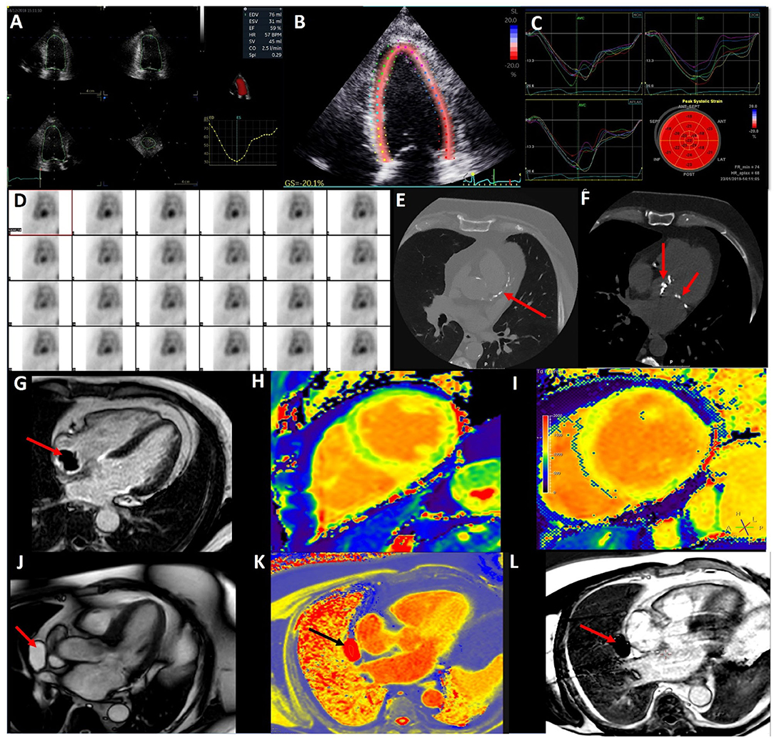 The Role of Strain Imaging in Oncology and Vendor-to-Vendor Variability -  American College of Cardiology