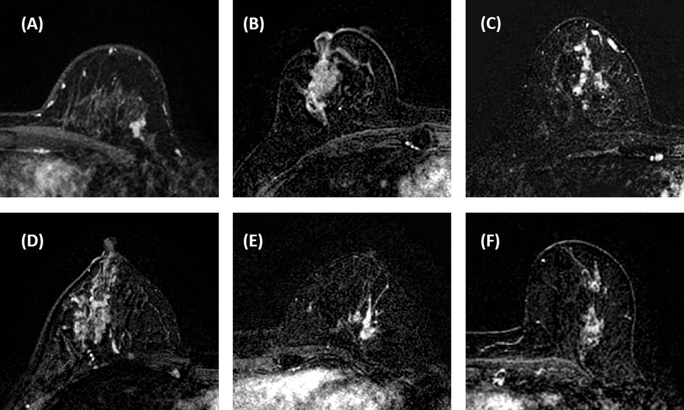 Frontiers  BI-RADS Reading of Non-Mass Lesions on DCE-MRI and Differential  Diagnosis Performed by Radiomics and Deep Learning