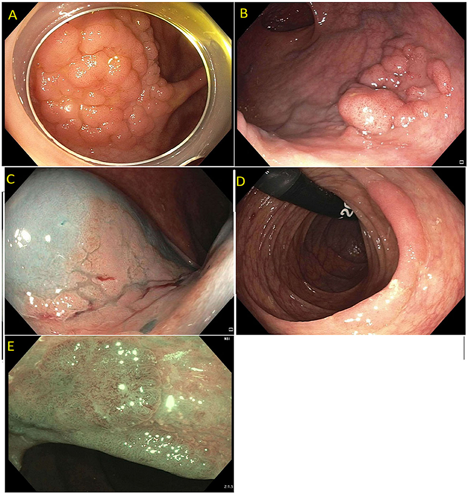 rectal polypectomy