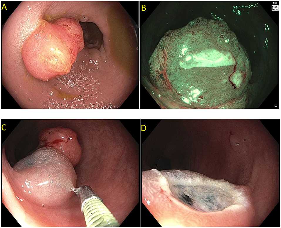Frontiers  Endoscopic Management of Complex Colorectal Polyps