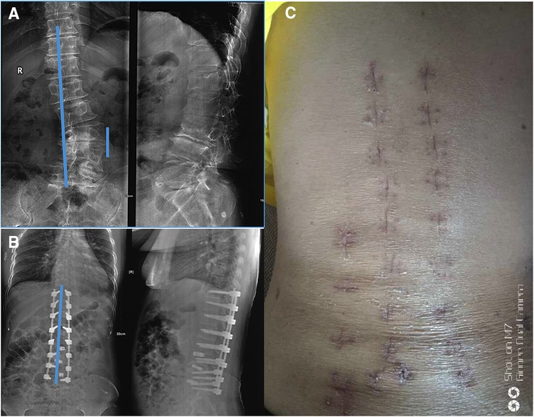 PDF) A review of minimally invasive techniques for correction of adult  spine deformity