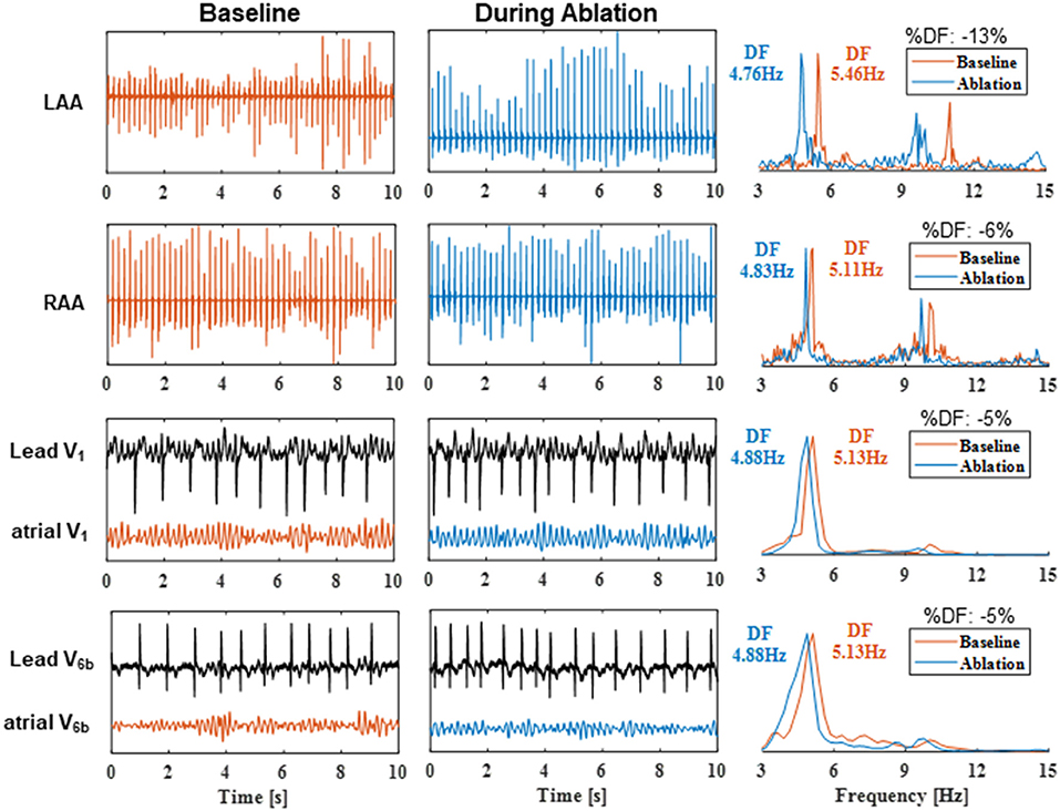 Arrhythmias - Treatments - Swiss Ablation