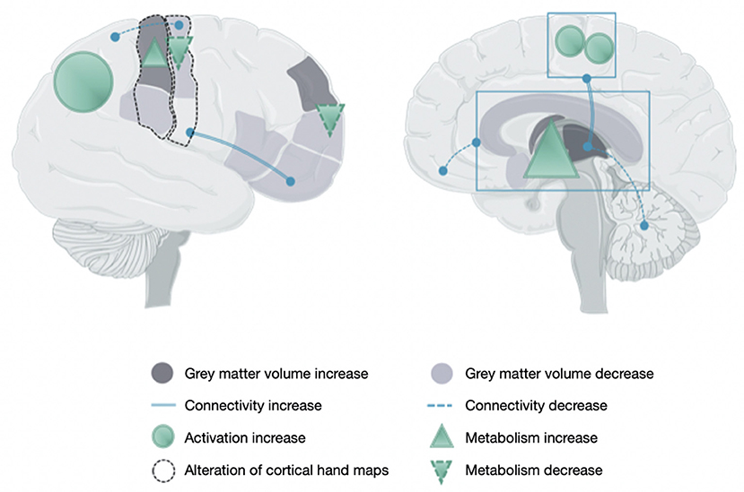 Complex Regional Pain Syndrome - LexiMed