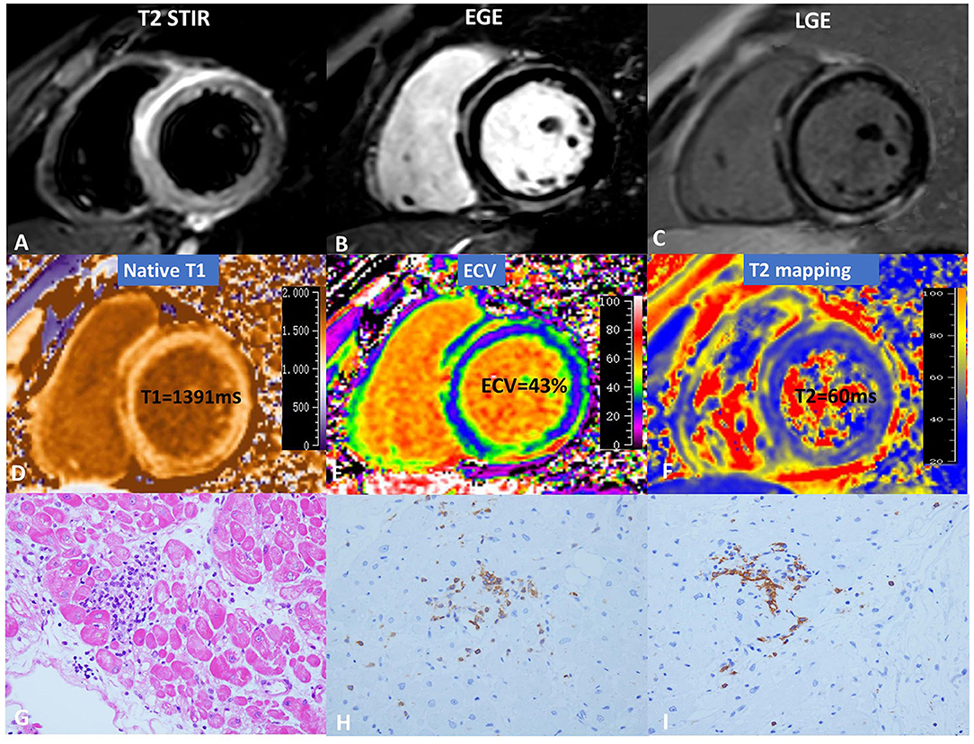 T2 Relaxation Times at Cardiac MRI in Healthy Adults: A Systematic