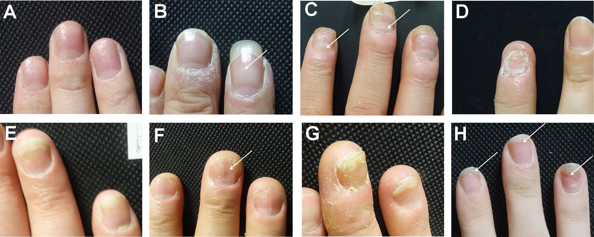 onycholysis psoriasis