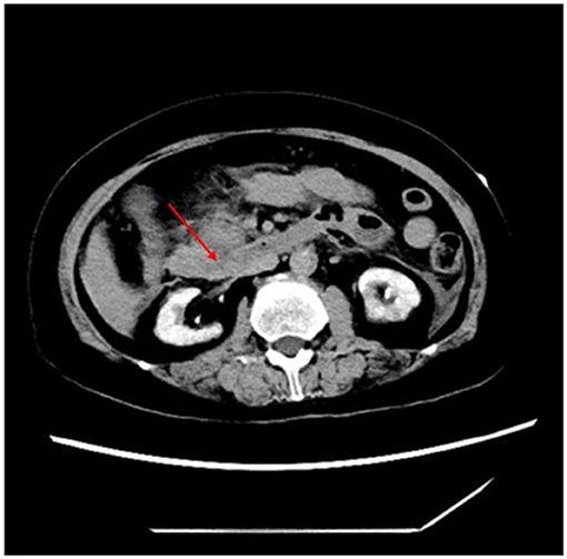 pyelonephritis és merevedés
