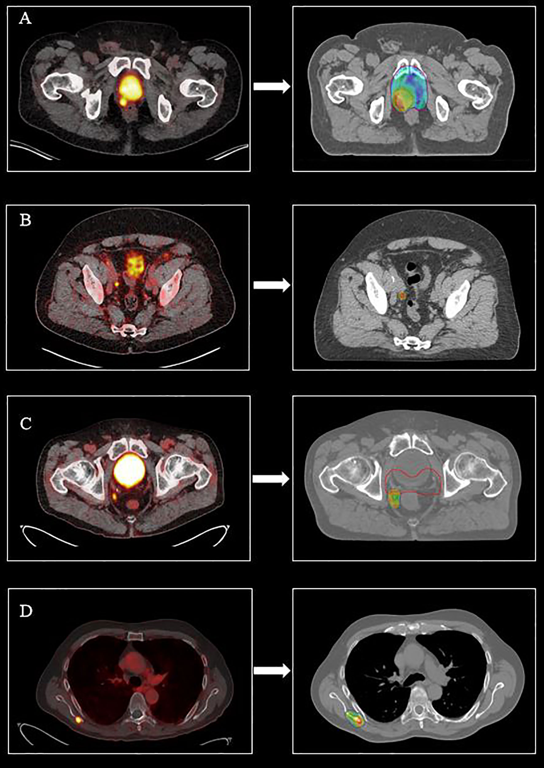 cancer prostate metastase forum