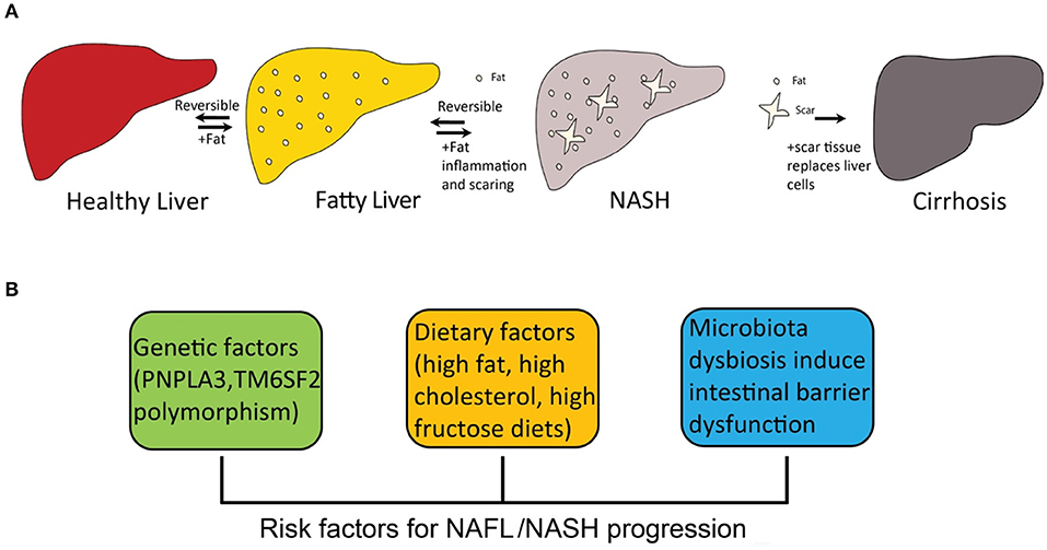Что такое стеатоз поджелудочной железы. Pathogenesis of fatty Liver disease. Fatty Liver Nash. Fatty Liver распространенность. Pathogenesis of alcoholic Liver disease.