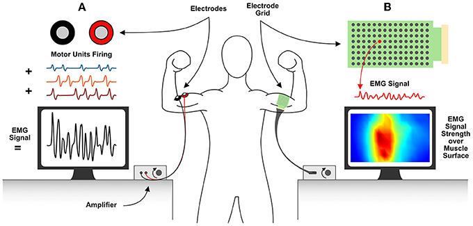 Figure 3 - EMG is the system used to record the electrical activity of muscles.